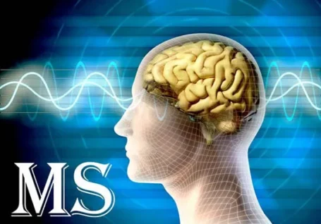 ۴۷۰ بیمار مبتلا به ام اس در رفسنجان تحت مراقبت هستند